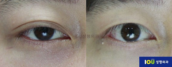 쌍꺼풀 있는 남자들은 필수로 해야하는 수술 | 인스티즈