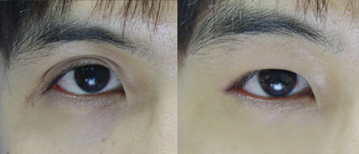 쌍꺼풀 있는 남자들은 필수로 해야하는 수술 | 인스티즈