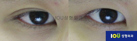 쌍꺼풀 있는 남자들은 필수로 해야하는 수술 | 인스티즈