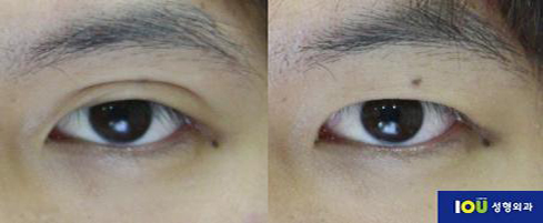 쌍꺼풀 있는 남자들은 필수로 해야하는 수술 | 인스티즈